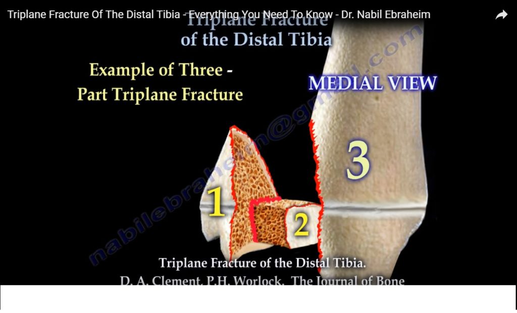 triplane-fracture-of-ankle-orthopaedicprinciples