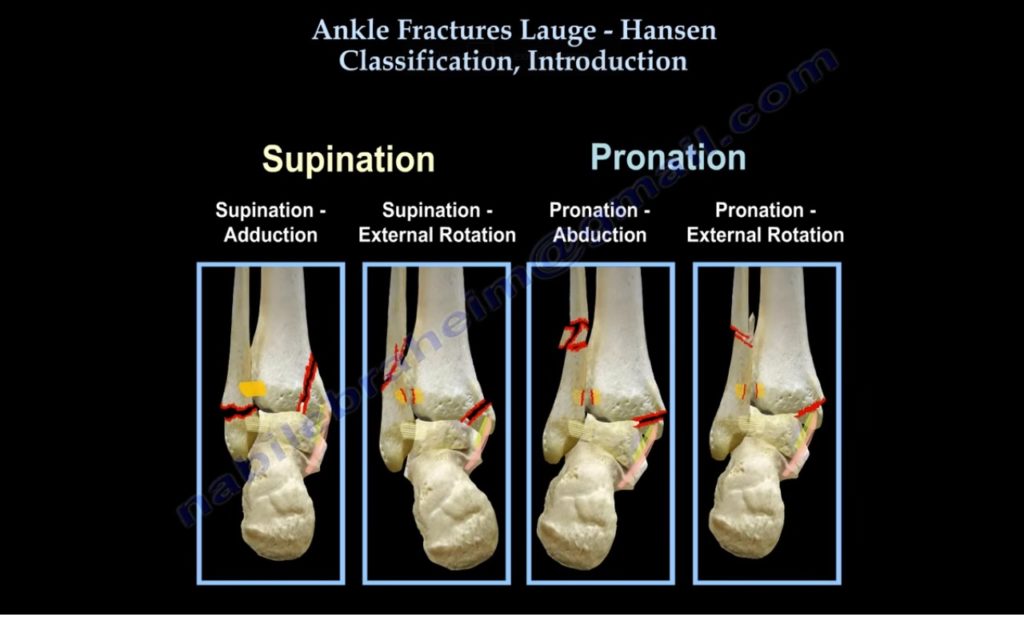 Lauge Hansen Classification of Ankle Fractures — OrthopaedicPrinciples.com