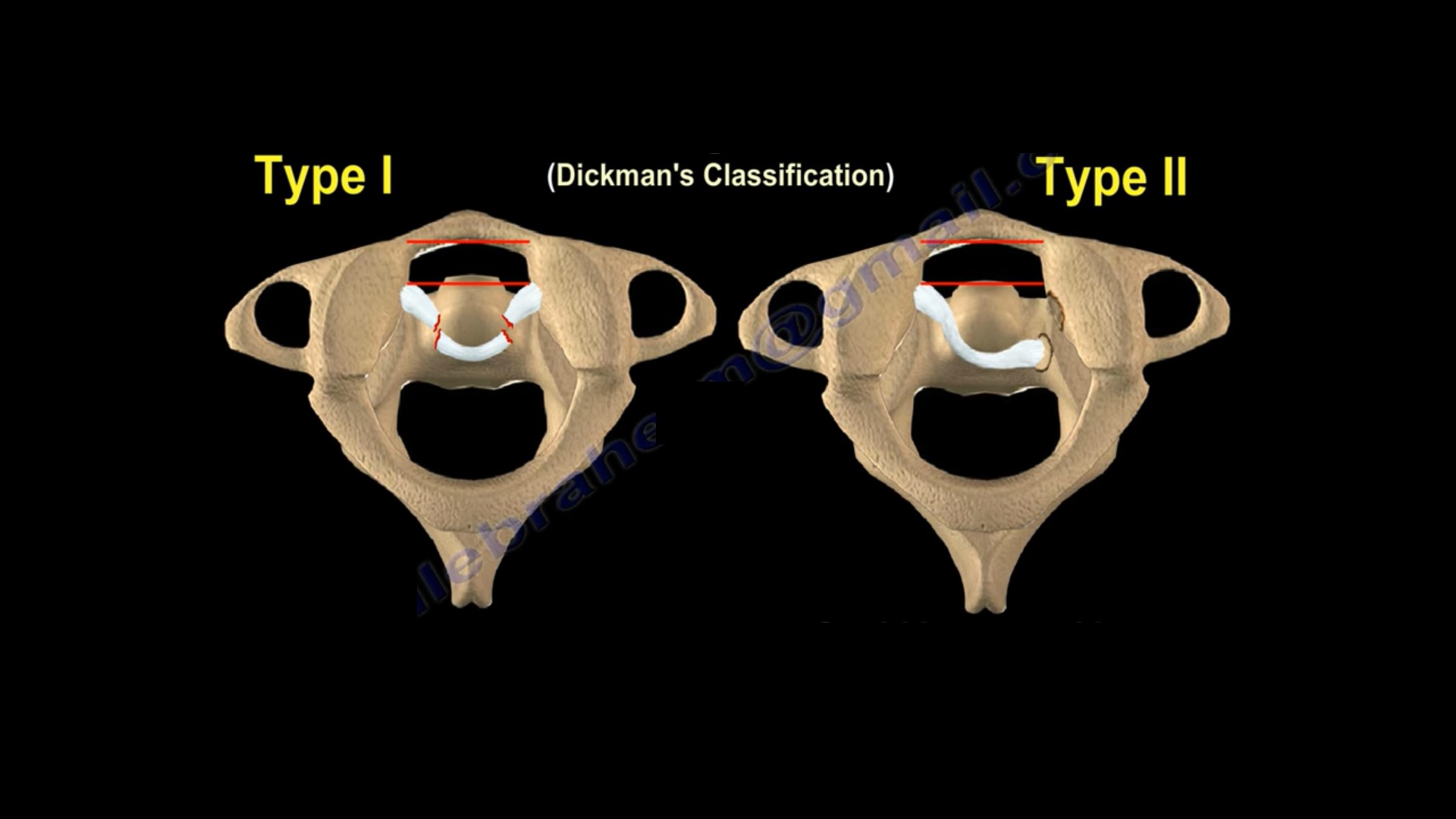 transverse-ligament-injury-of-cervical-spine-orthopaedicprinciples