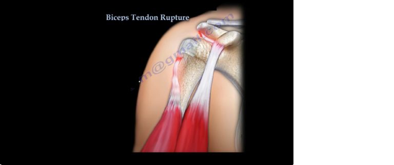 Proximal Biceps Tendon Rupture — 0455