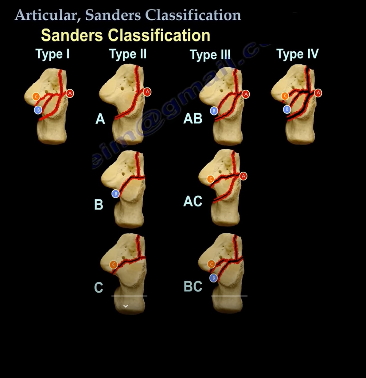 Calcaneal Fracture Classification