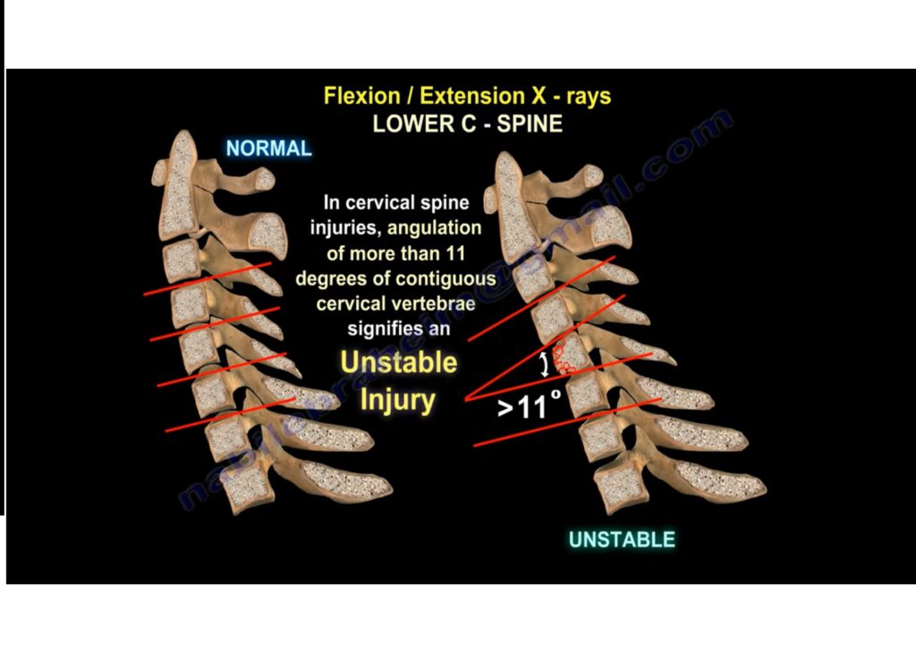 unstable cervical spine flexion x ray