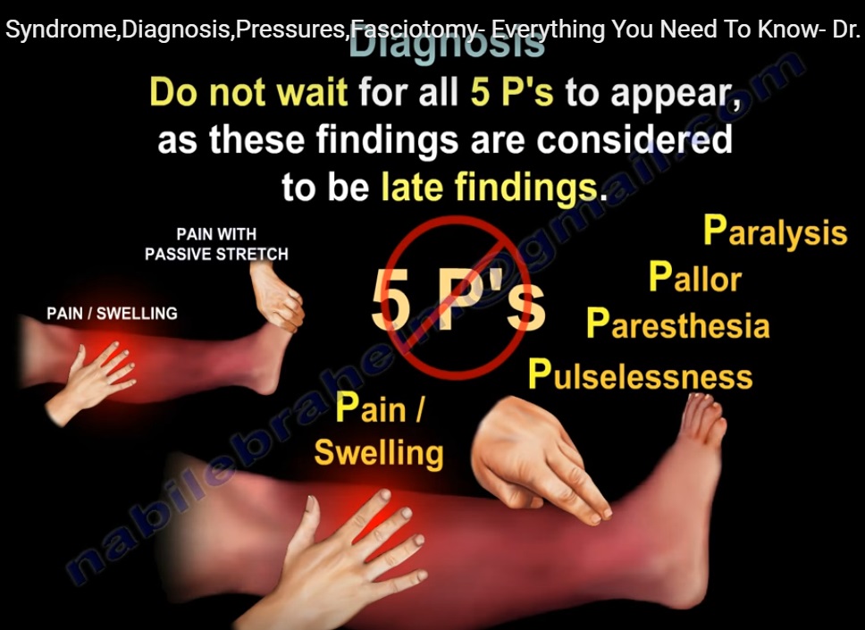 compartment-pressure-monitoring-and-fasciotomy-orthopaedicprinciples