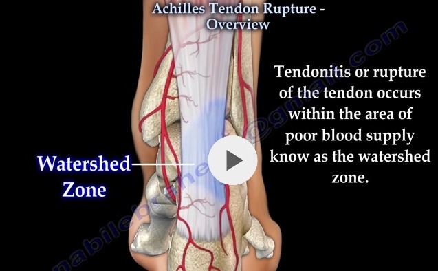 Achilles Tendon Rupture — OrthopaedicPrinciples.com