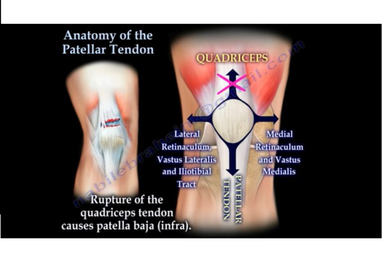 patellar-tendon-rupture-repair