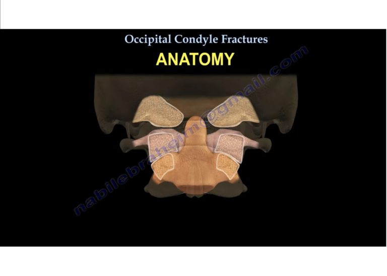 Occipital Condyle Fractures — 7759