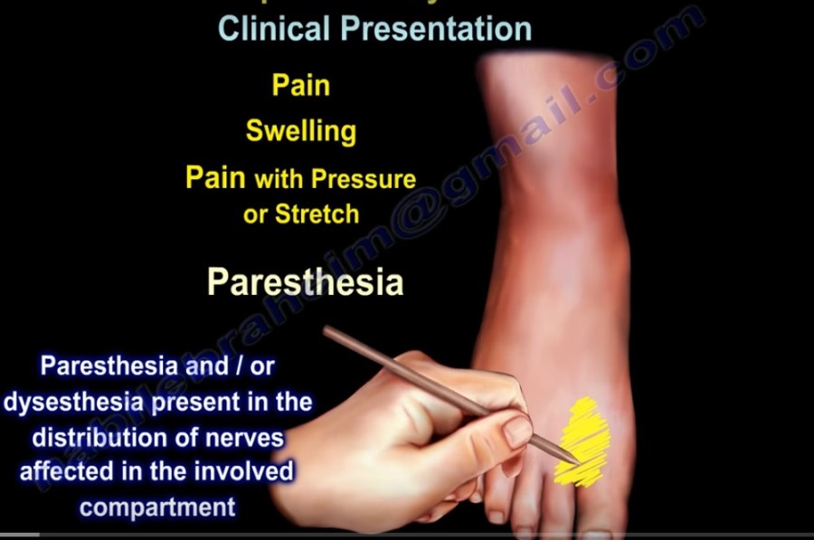 Compartment syndrome что это