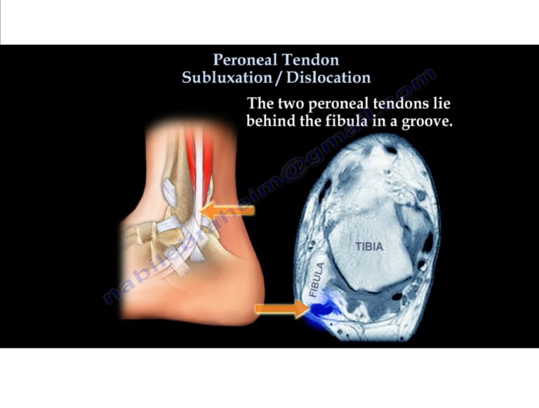 Peroneal Tendon Subluxation/Dislocation — OrthopaedicPrinciples.com