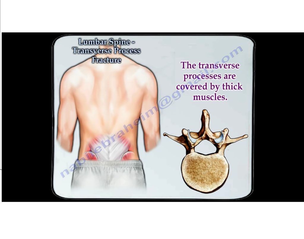 lumbar-spine-transverse-process-fracture-orthopaedicprinciples