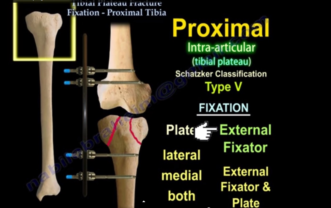 Tibial Plateau Fractures —