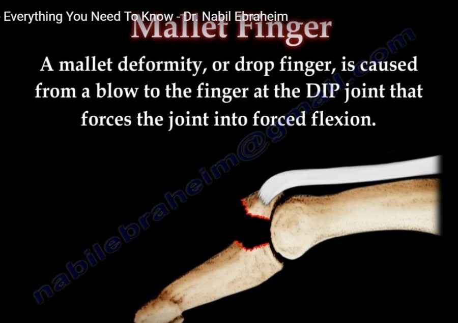 Mallet Finger Mechanism at Arnoldo Harold blog