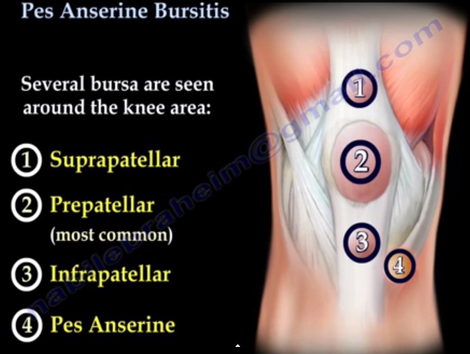 Pes Anserine Bursitis — OrthopaedicPrinciples.com
