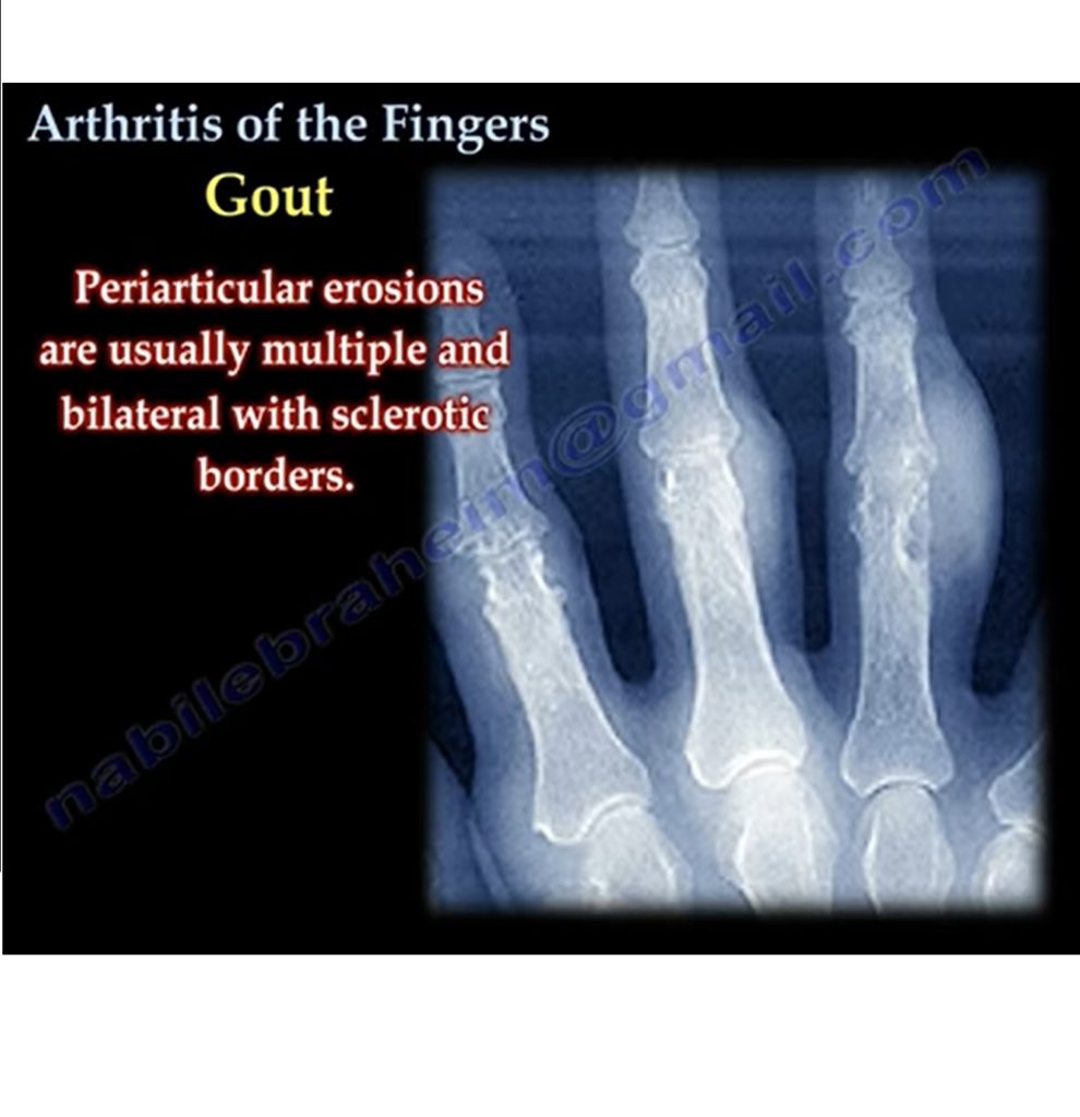 Finger Joint Arthritis — OrthopaedicPrinciples.com