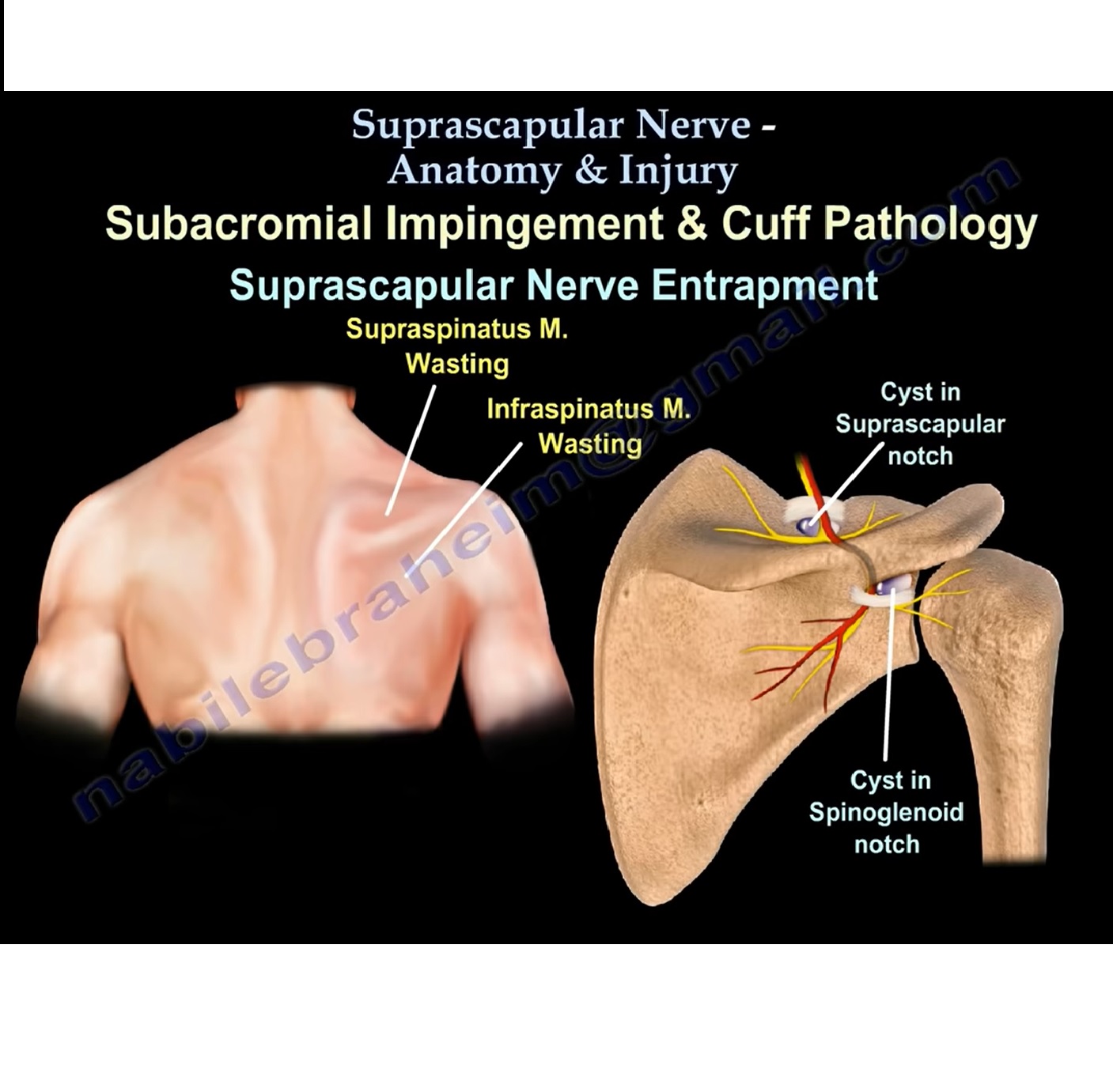 Suprascapular Nerve Anatomy Orthopaedicprinciples Com