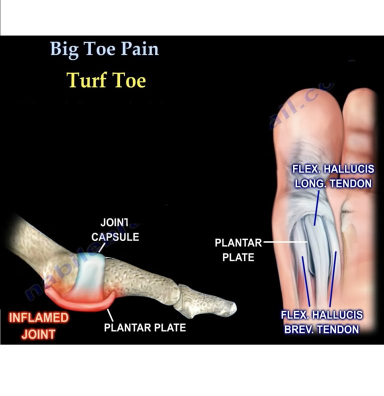 Pain On Pad Below Big Toe at Steven Struck blog