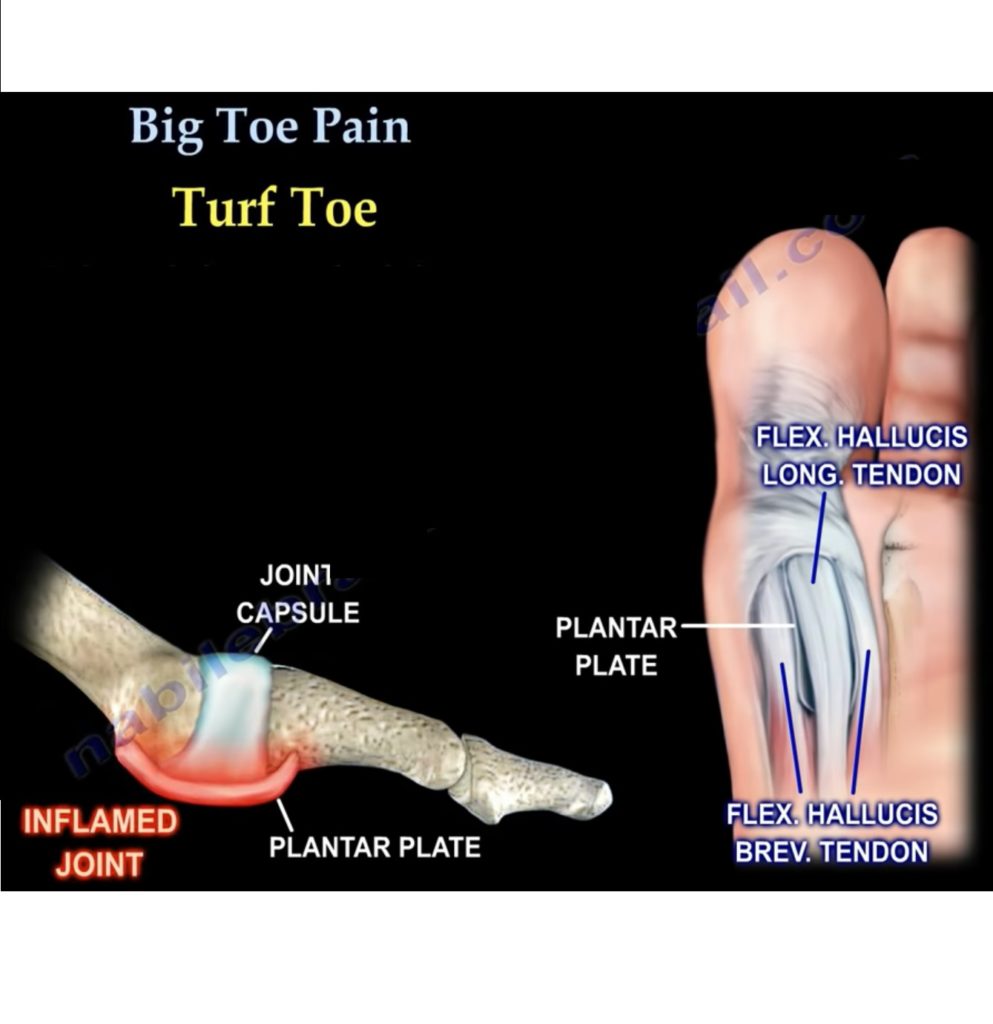 Great toe Pain —