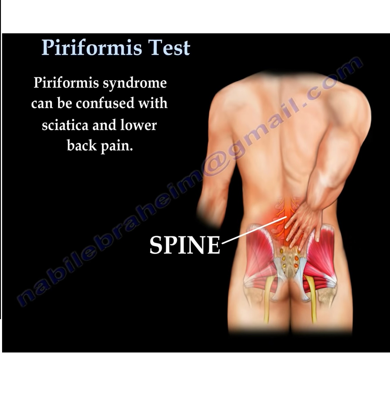 Piriformis Syndrome —