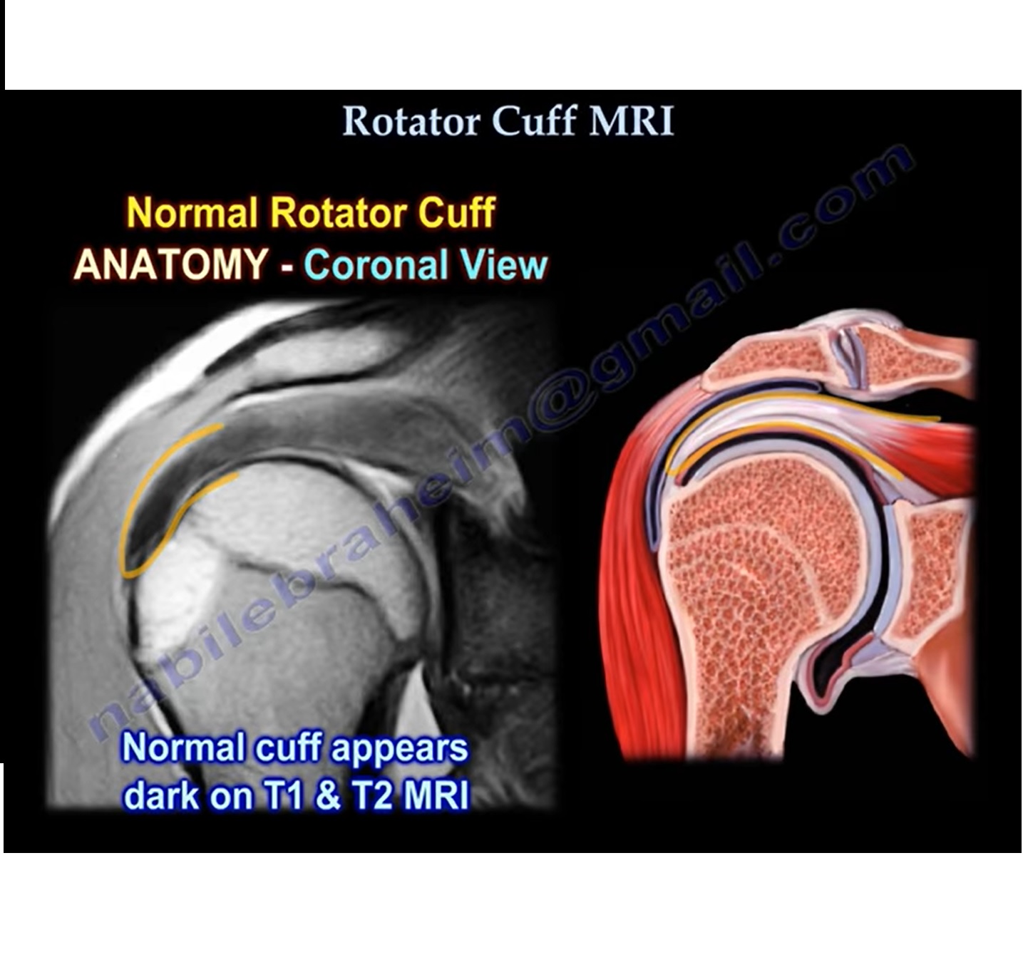 Shoulder Anatomy And MRI Evaluation OrthopaedicPrinciples