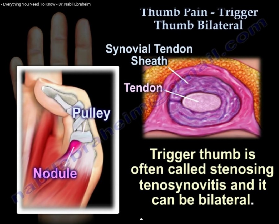 Trigger thumb basics orthopaedicprinciples