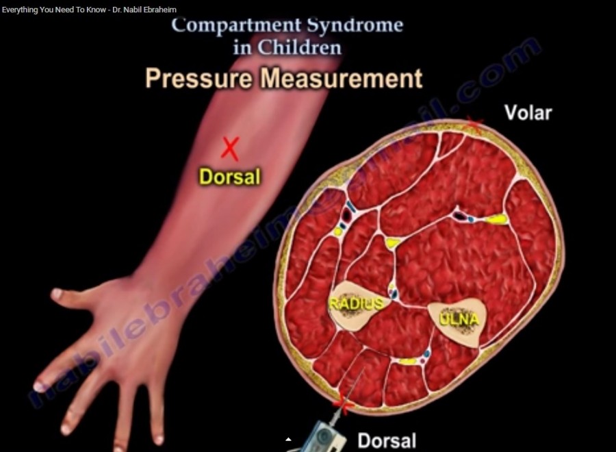 Compartment syndrome что это