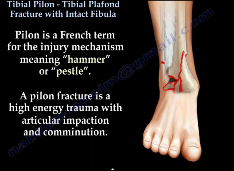 Tibial Pilon Fracture-with Intact fibula — OrthopaedicPrinciples.com