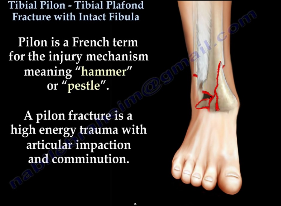 Tibial Pilon Fracture With Intact Fibula —