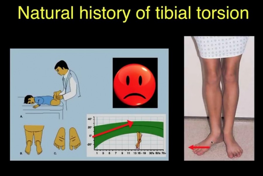 External Tibial Torsion by Prof Lynn Staheli —