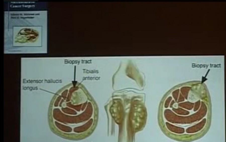 Biopsy In A Suspected Tumour Case When And How 