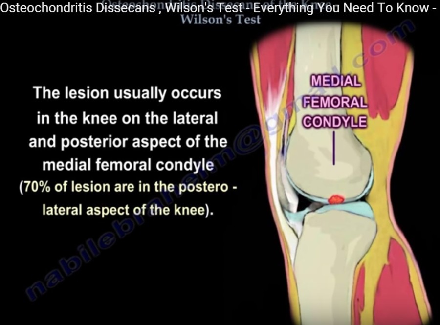 icd 10 code for osteochondritis dissecans left knee