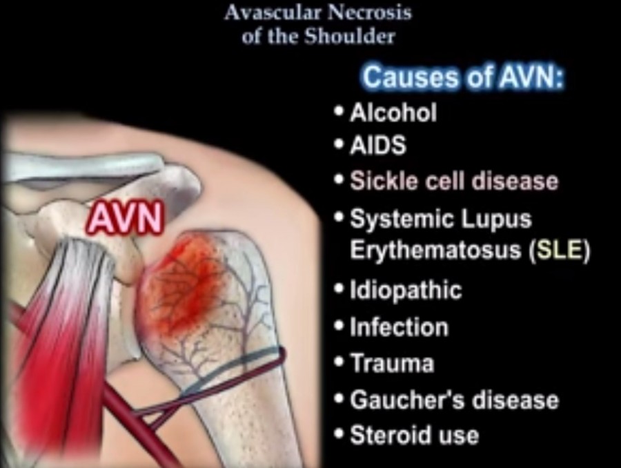 Avascular Necrosis Of Shoulder — 4437