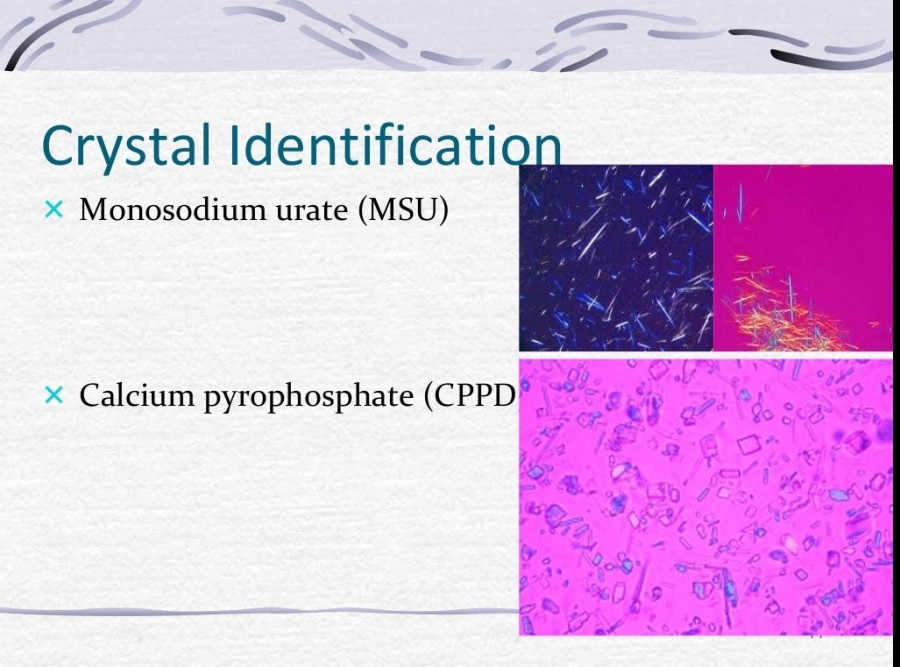 Clinical Applications Of Synovial Joint Fluid Analysis — 6052