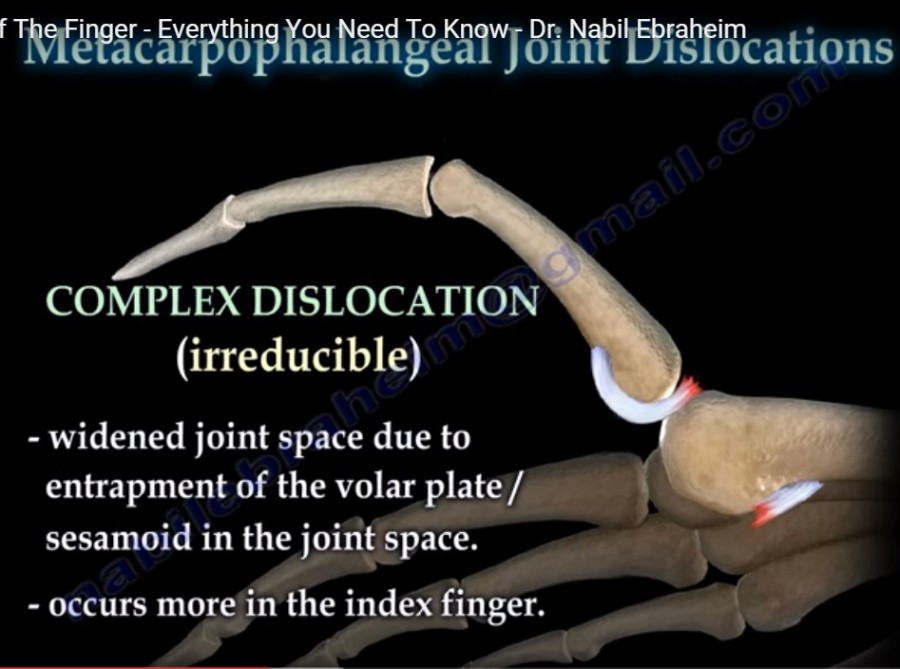 Finger Joint #Dislocations — OrthopaedicPrinciples.com