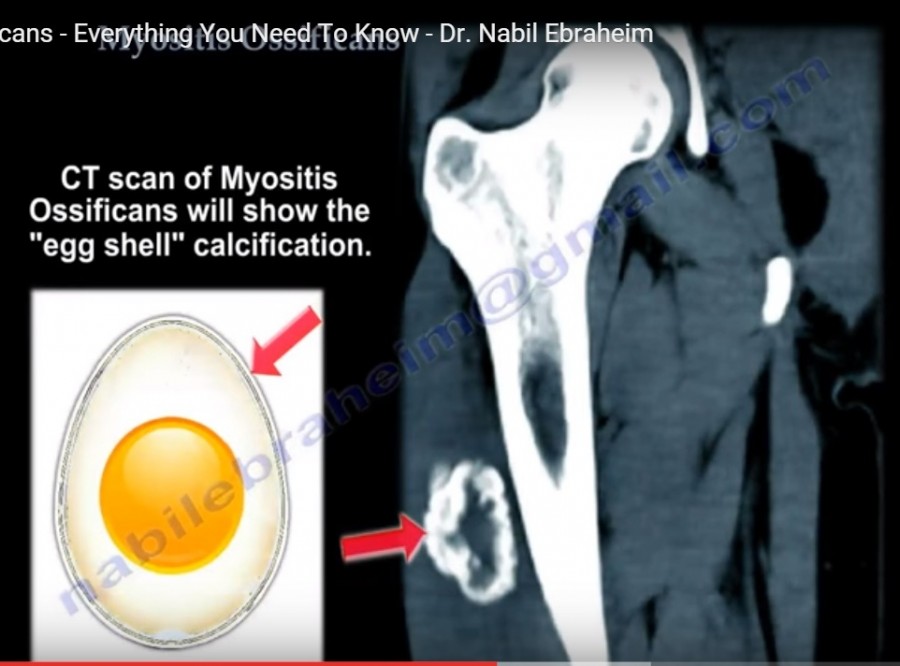 myositis-ossificans-orthopaedicprinciples