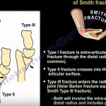 Distal Radius Fractures