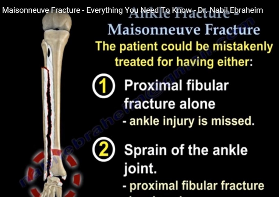 Maisonneuve fracture — OrthopaedicPrinciples.com