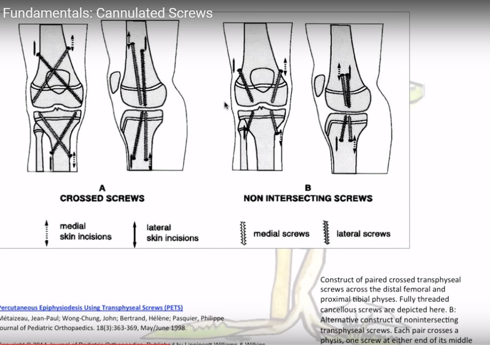 Epiphysiodesis Using Cannulated Screws OrthopaedicPrinciples