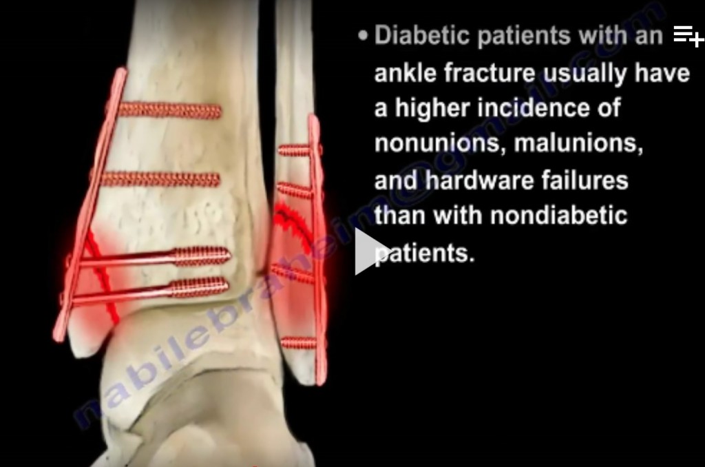 Diabetic #Ankle Fractures — OrthopaedicPrinciples.com