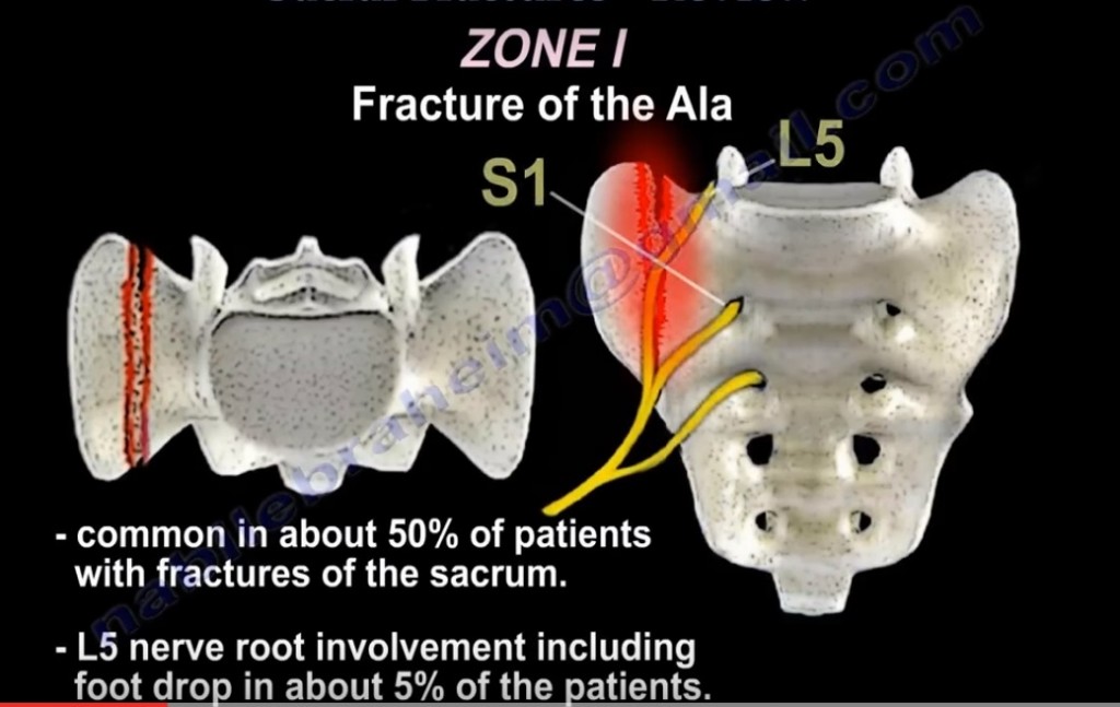 Sacral Fractures — OrthopaedicPrinciples.com