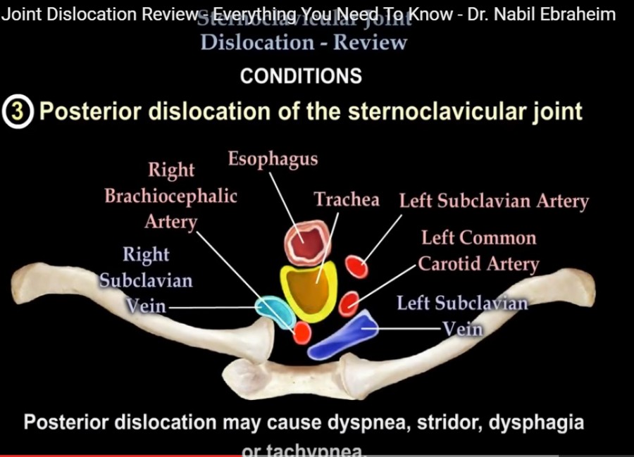 Sternoclavicular Dislocation —
