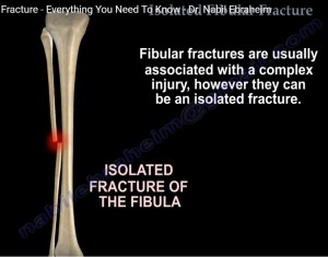 Isolated Fibula fractures — OrthopaedicPrinciples.com