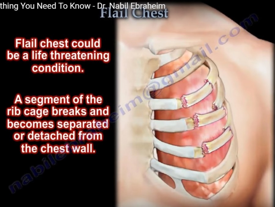 Flail Chest — OrthopaedicPrinciples.com