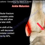 Ankle Fractures: Types, Symptoms and Treatment