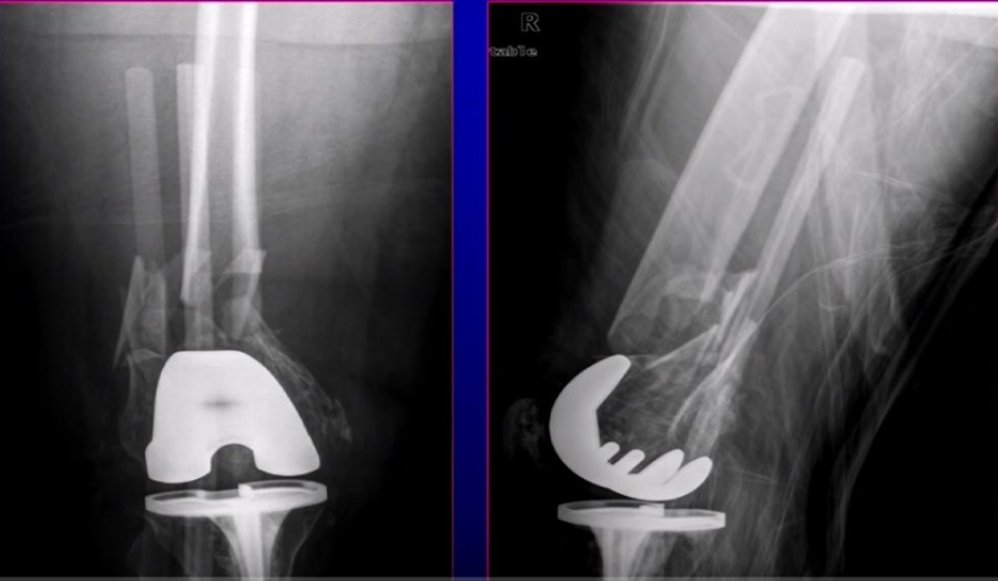 Nailing Vs Plating For Distal Femoral Periprosthetic Fractures ...