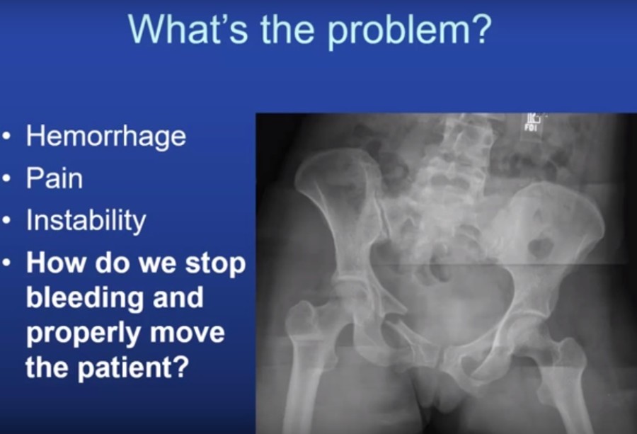 pelvic-fracture-basics-orthopaedicprinciples