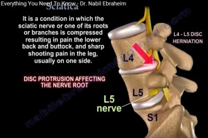 Sciatica — OrthopaedicPrinciples.com