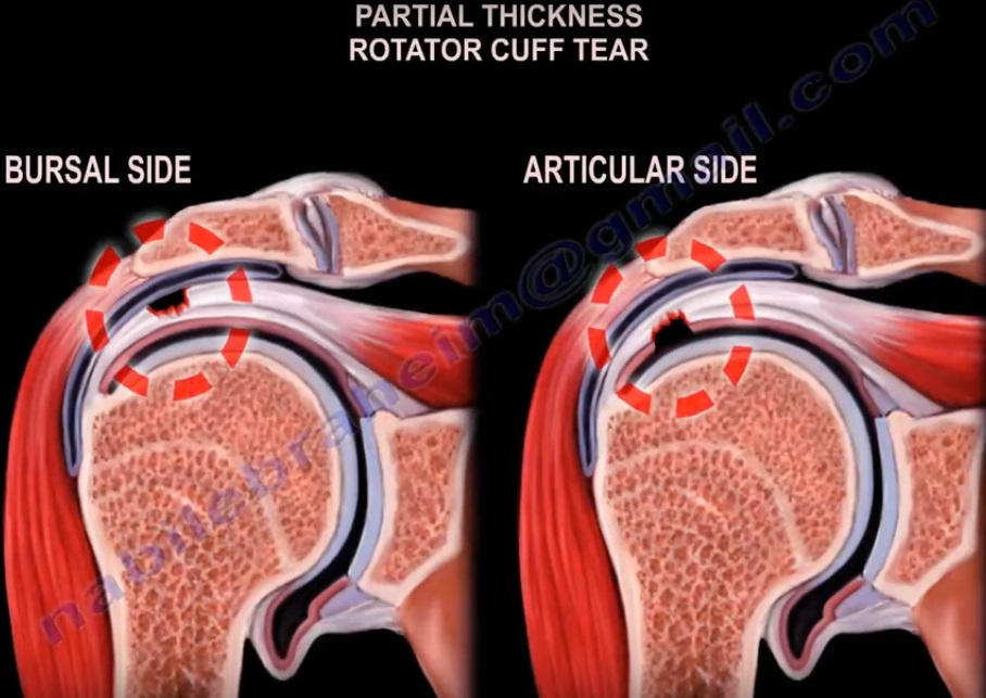 rotator-cuff-tear-classification-orthopaedicprinciples