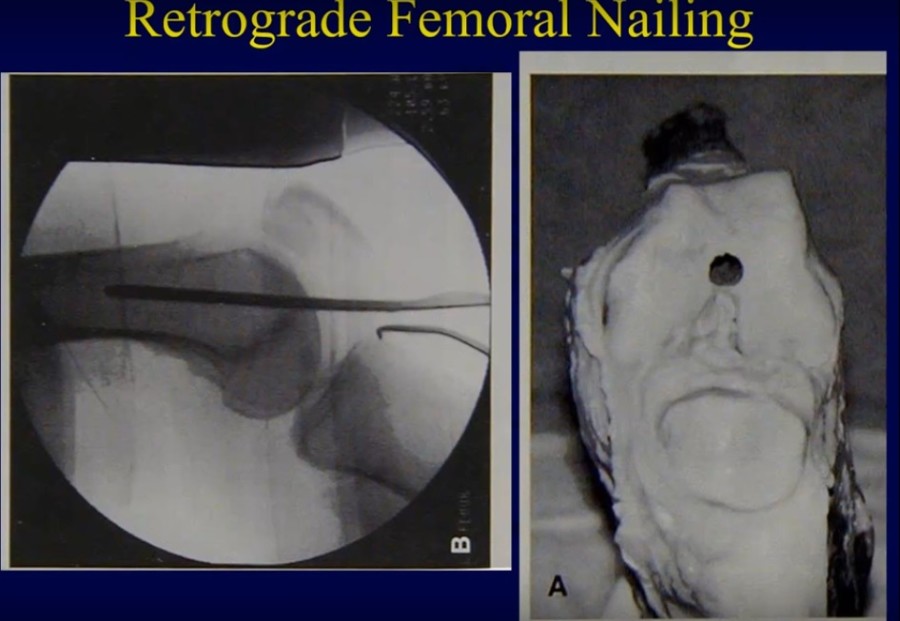 Distal Femur Fractures – Retrograde Nailing And Traditional Plating ...