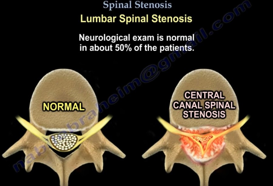 Spine Concepts Lumbar canal Stenosis —