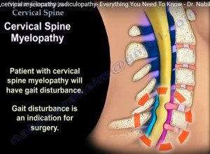 Cervical Myelopathy, Radiculopathy — OrthopaedicPrinciples.com