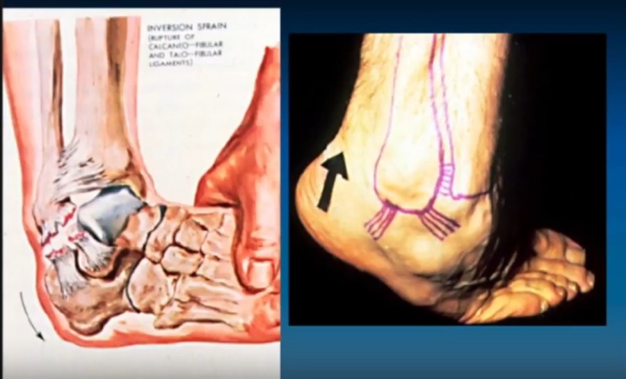 Ankle Rptation Injury Ankle Injuries and Gait — OrthopaedicPrinciples.com